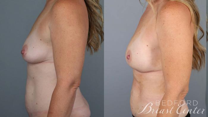 Before & After Nipple Sparing Mastectomy with One-Stage Breast Reconstruction Case 38 Left Side View in Beverly Hills, Los Angeles, Santa Monica, Glendale, and Malibu, CA