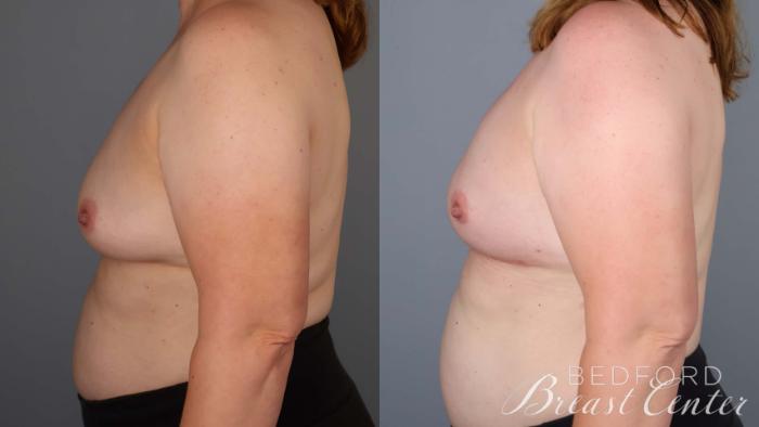 Before & After Nipple Sparing Mastectomy with One-Stage Breast Reconstruction Case 39 Left Side View in Beverly Hills, Los Angeles, Santa Monica, Glendale, and Malibu, CA