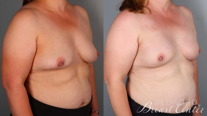 Before & After Nipple Sparing Mastectomy with One-Stage Breast Reconstruction Case 39 Right Oblique View in Beverly Hills, Los Angeles, Santa Monica, Glendale, and Malibu, CA