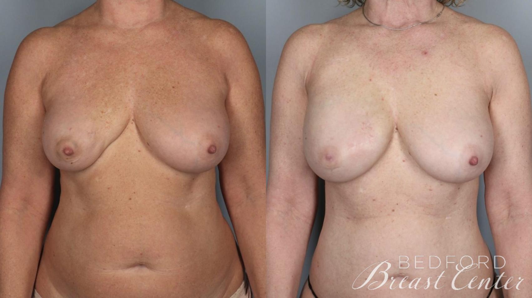 Before & After Nipple Sparing Mastectomy with One-Stage Breast Reconstruction Case 5 Front View in Beverly Hills, Los Angeles, Santa Monica, Glendale, and Malibu, CA